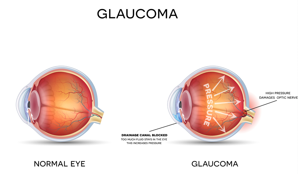 Normal Eye vs Glaucoma